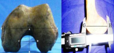 Figure 1: Photographs showing the measurement of the parameters (AB-intercondylar notch depth; CD-intercondylar notch width; EF-condylar width; GH-condylar depth)